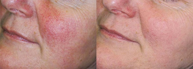 IPL-before-and-after