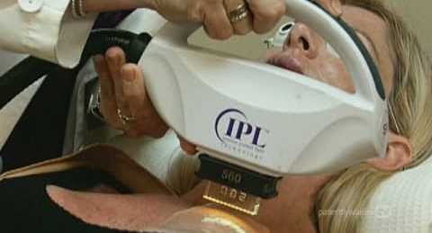 ipl-photorejuvenation