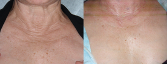 IPL-before-and-after