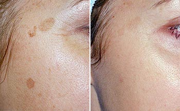 IPL-before-and-after